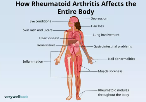 Graphic Shows Effects of Rheumatoid Arthritis on a Woman's Body